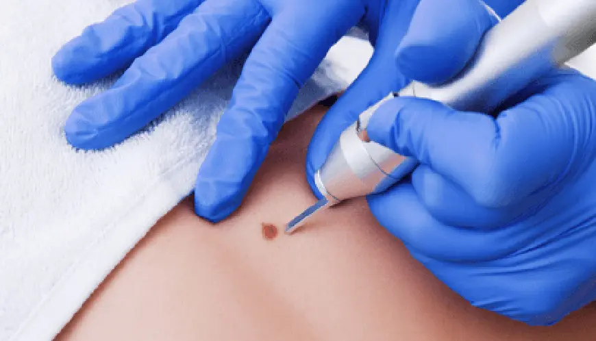Birthmarks removal treatment in bhubaneswar