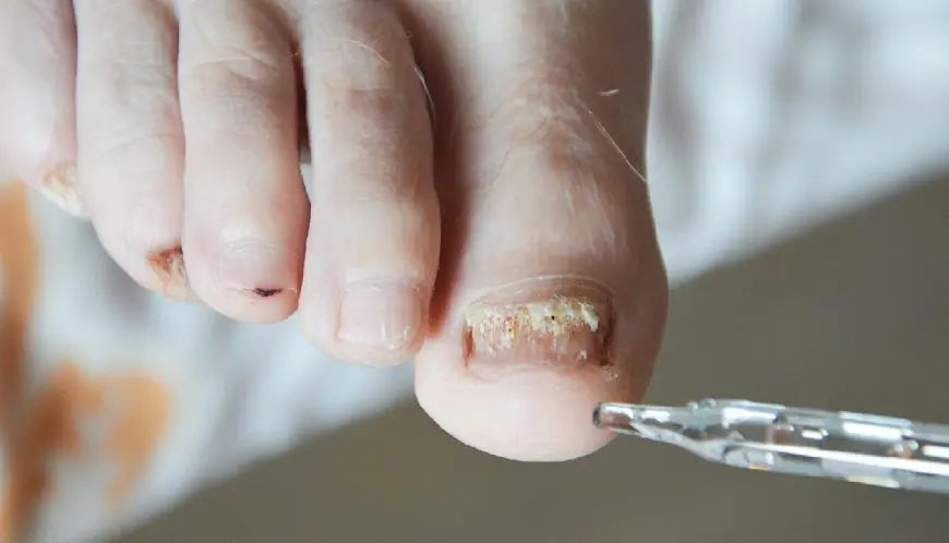 Nail Infection Treatment in Bhubaneswar