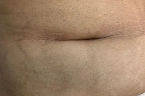 After Stretch Marks Removal