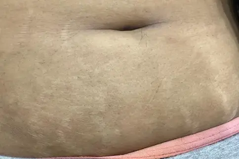 Before Stretch Marks Removal